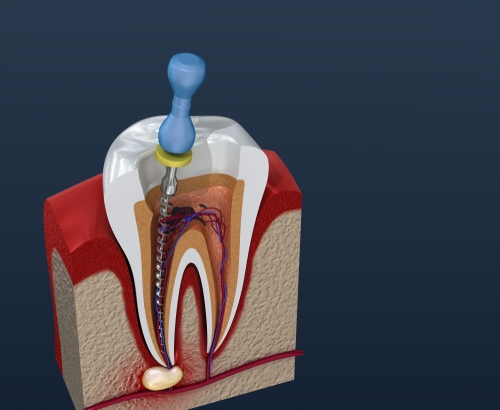 Root Canal Treatment in bangalore