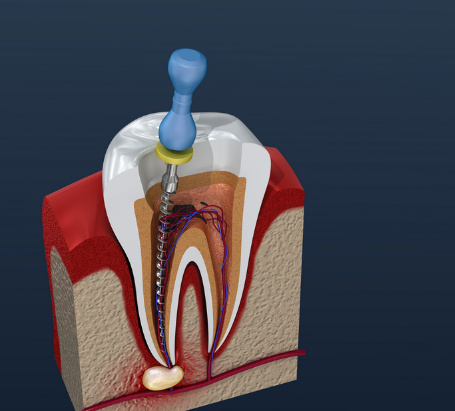 Root Canal