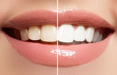 Teeth whitening