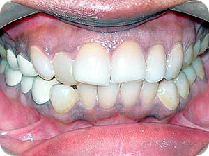Crowded and Proclined Teeth