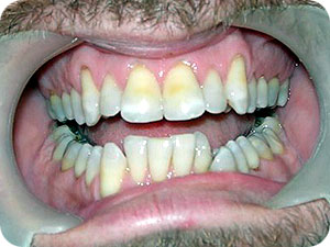 Proclined Teeth With Deepbite