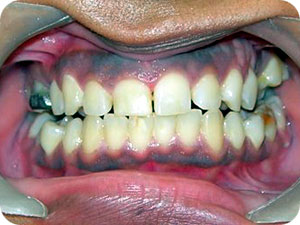 Stained Teeth With Gaps