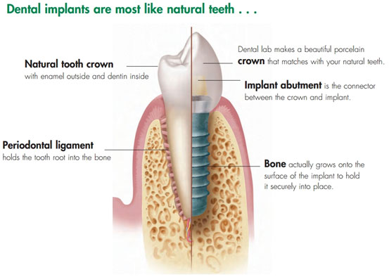 Dental Implants