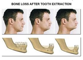 Tooth Extraction Cost