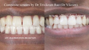 Composite Veneers