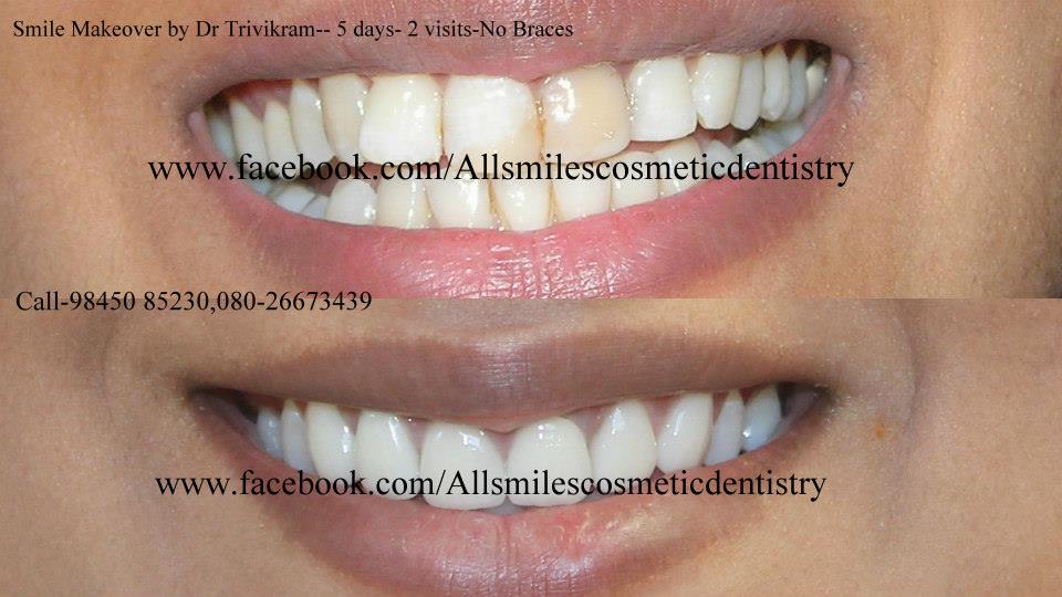 Instant Teeth Whitening