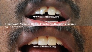Dental Veneers 