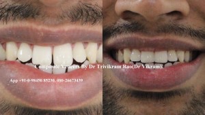 Porcelain Dental Veneers 