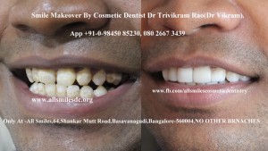 Smile Makeover