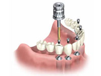 Implant supported dentures 