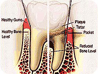 Gum treatment