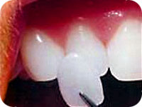 Ceramic veneers 