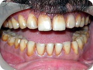Discolored Teeth