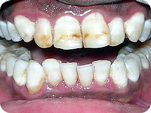 Discoloured Teeth