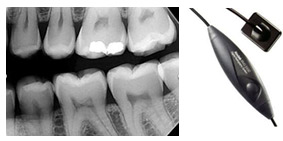 Low Radiation Digital X Rays