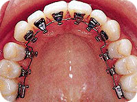 Orthodontic treatment