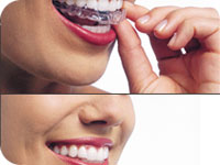 Invisible Braces Cost 