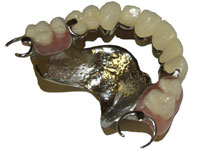 Partial Dentures