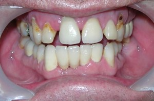 Cavities on the Front Teeth