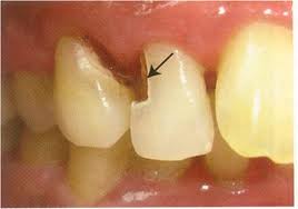 Decayed front teeth