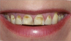 Erosion of Teeth