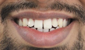 Tooth Gap