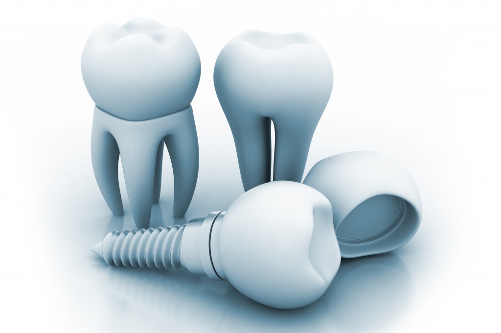 dental-implants-in-bangalore