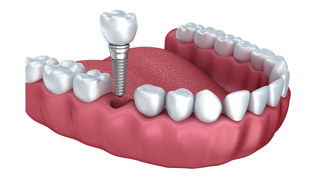 Best Dental Implant clinic in banglore