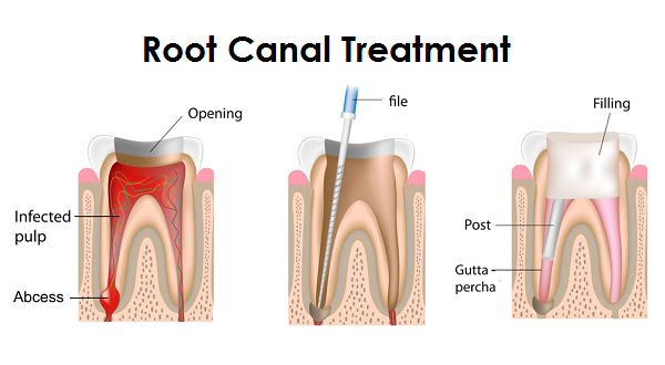 Root Canal Treatment Cost Bangalore