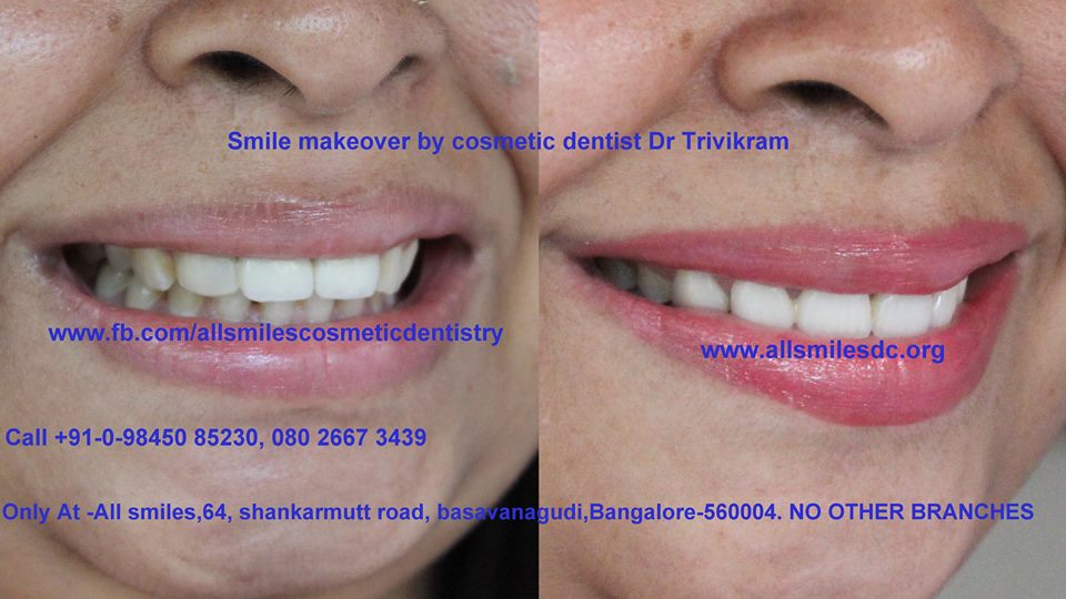 tooth discoloration treatment india