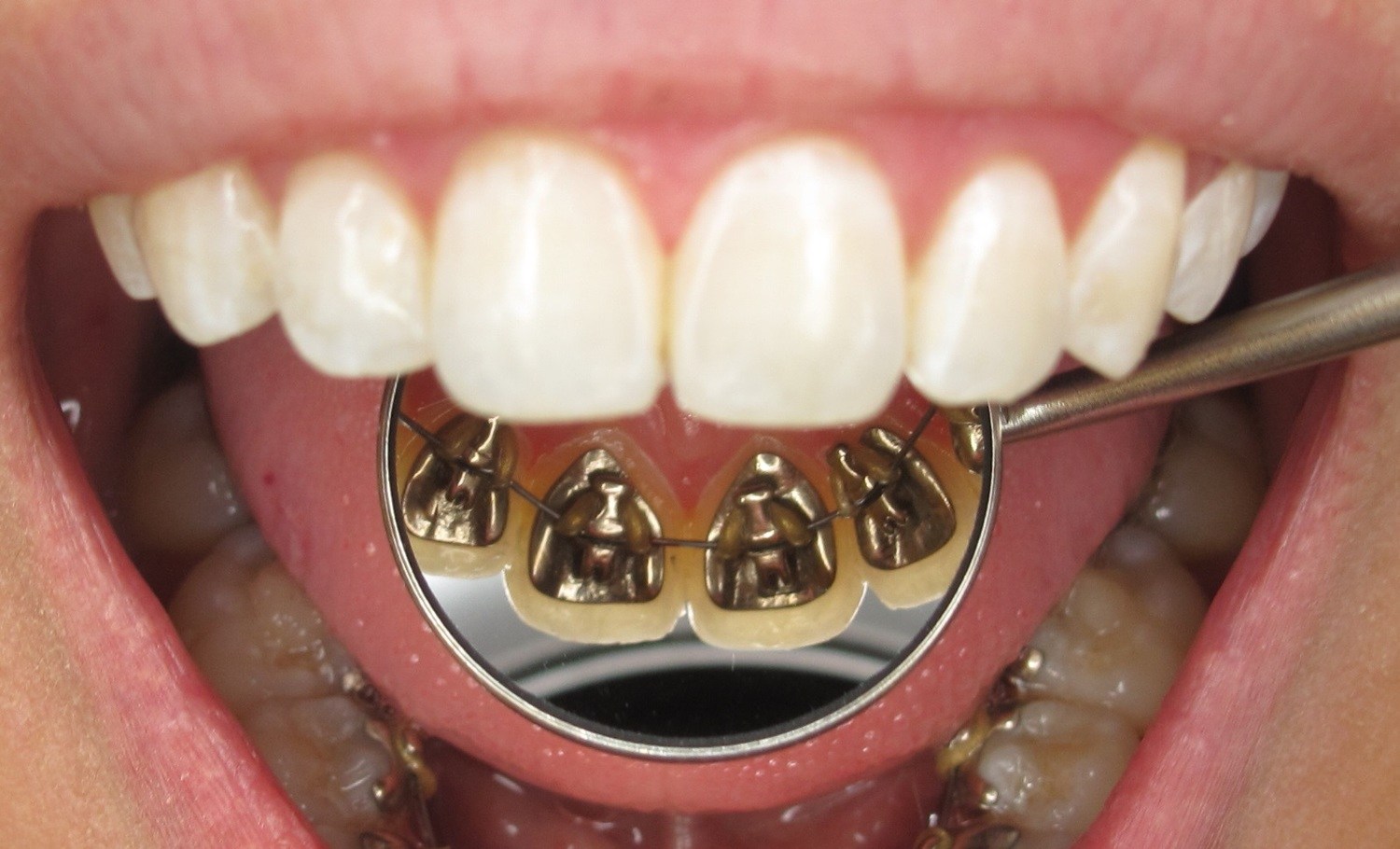 lingual braces