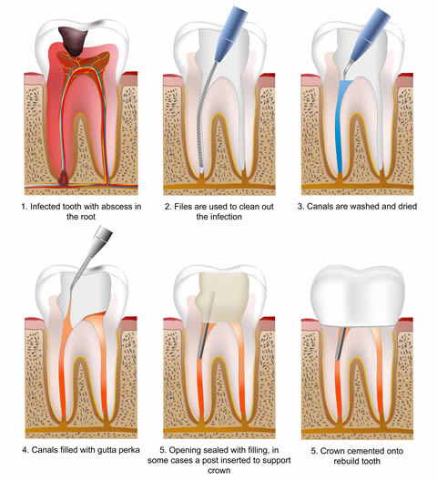 root canal treatment bangalore